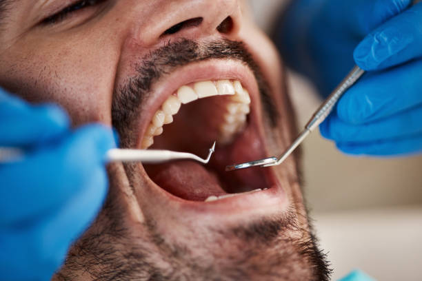 Best Emergency Treatment for Dental Infections or Abscesses in Langley Park, MD